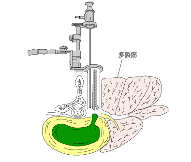 図:内視鏡下腰椎椎間板ヘルニア摘出術