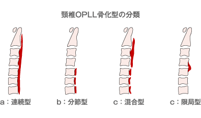 頸椎OPLL骨化型の分類