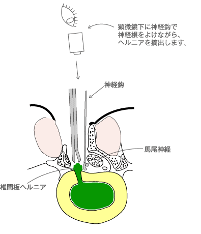 図:顕微鏡下腰椎椎間板ヘルニア摘出術