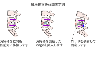 図:腰椎後方椎体間固定術