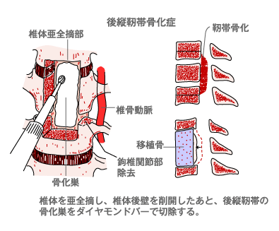 図:後縦靱帯骨化症